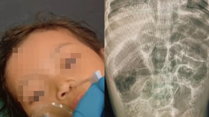Kemenkes Buka Suara soal Kasus Bocah Sukabumi Meninggal Akibat Infeksi Cacing